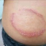 Signos de Infecciones en la Piel y Remedios Naturales