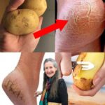 Elimina los Talones Agrietados: Consejos Naturales con Papas