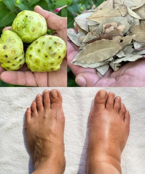 Frutas noni, hojas de laurel y comparación de pies hinchados