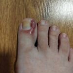 Cómo Tratar un Uñero o Uña Encarnada: Remedios Naturales y Consejos Prácticos