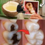 Consejos para Evitar Visitas al Dentista y Remedios Naturales para Caries