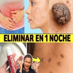 Di adiós a las verrugas y los lunares cutáneos: el método natural que funciona