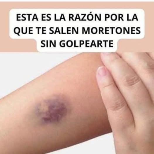Mucho Cuidado: Esta es la Razón por la que Te Salen Moretones en el Cuerpo Sin Golpearte
