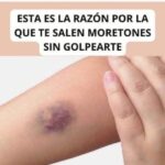 Mucho Cuidado: Esta es la Razón por la que Te Salen Moretones en el Cuerpo Sin Golpearte