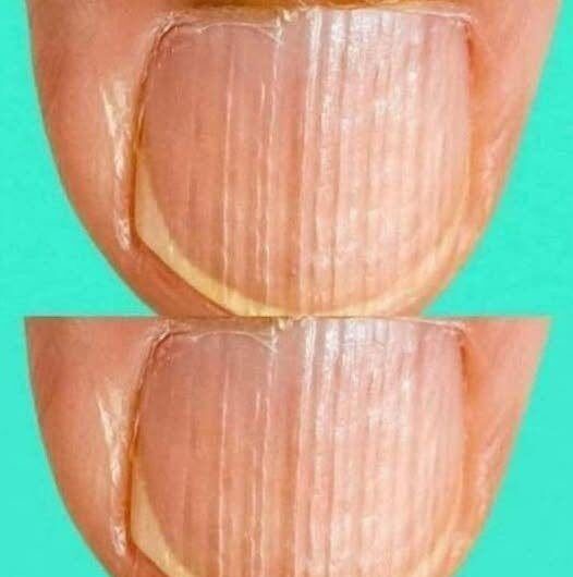 Cuidado: ¿Por Qué Salen Líneas en las Uñas y Cómo Eliminarlas Correctamente?