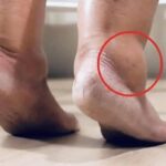 ¿Sabías que los Pies Hinchados Pueden Ser una Señal de Alerta? Descubre las Causas y Remedios Naturales