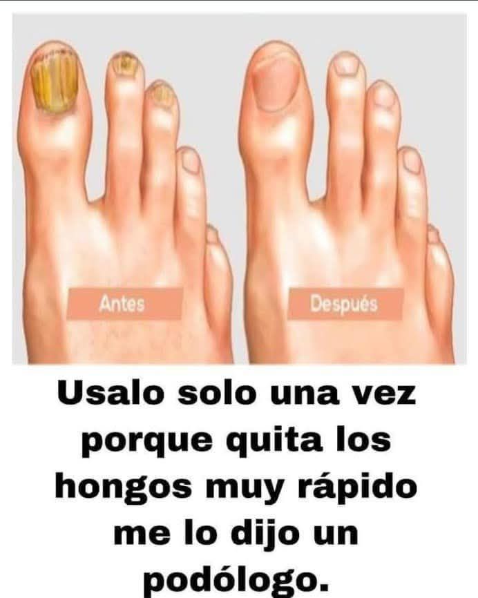 Antes y Después del Tratamiento de Hongos en Uñas