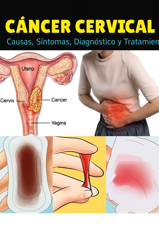 Cáncer Cervical: Causas, Síntomas, Diagnóstico y Tratamiento
