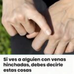 Entendiendo las Venas Hinchadas: Significado y Remedios Naturales