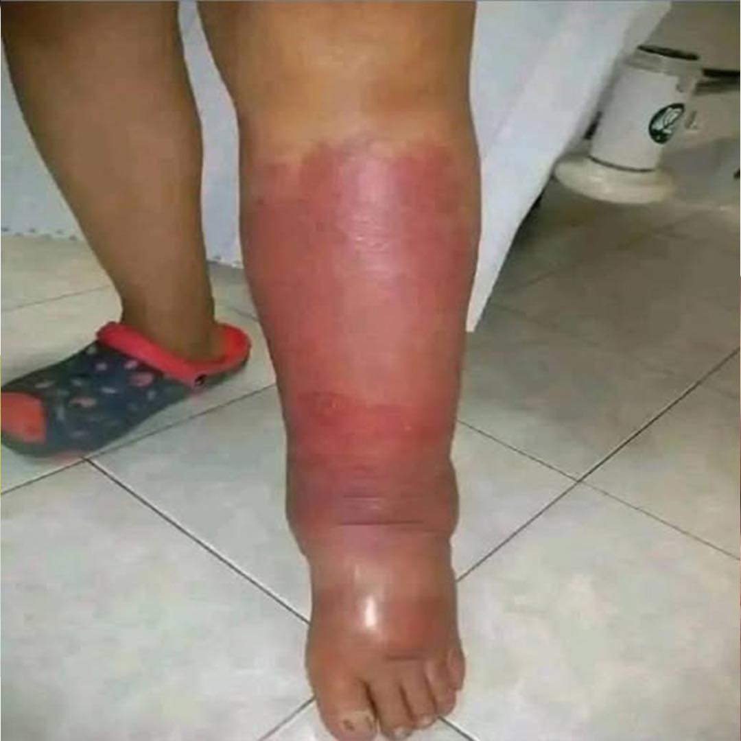 Pierna con hinchazón y enrojecimiento