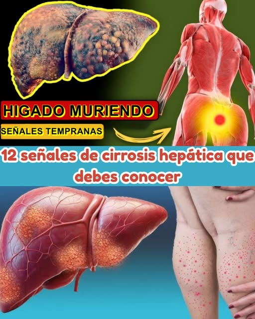 Señales de Cirrosis Hepática