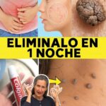 Elimina Verrugas y Lunares de Manera Natural: Una Receta Sorpresa con Yodo