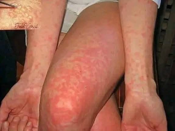 Erupciones cutáneas en brazos y piernas