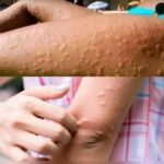 Identificación y Tratamiento Natural de la Queratosis Pilaris
