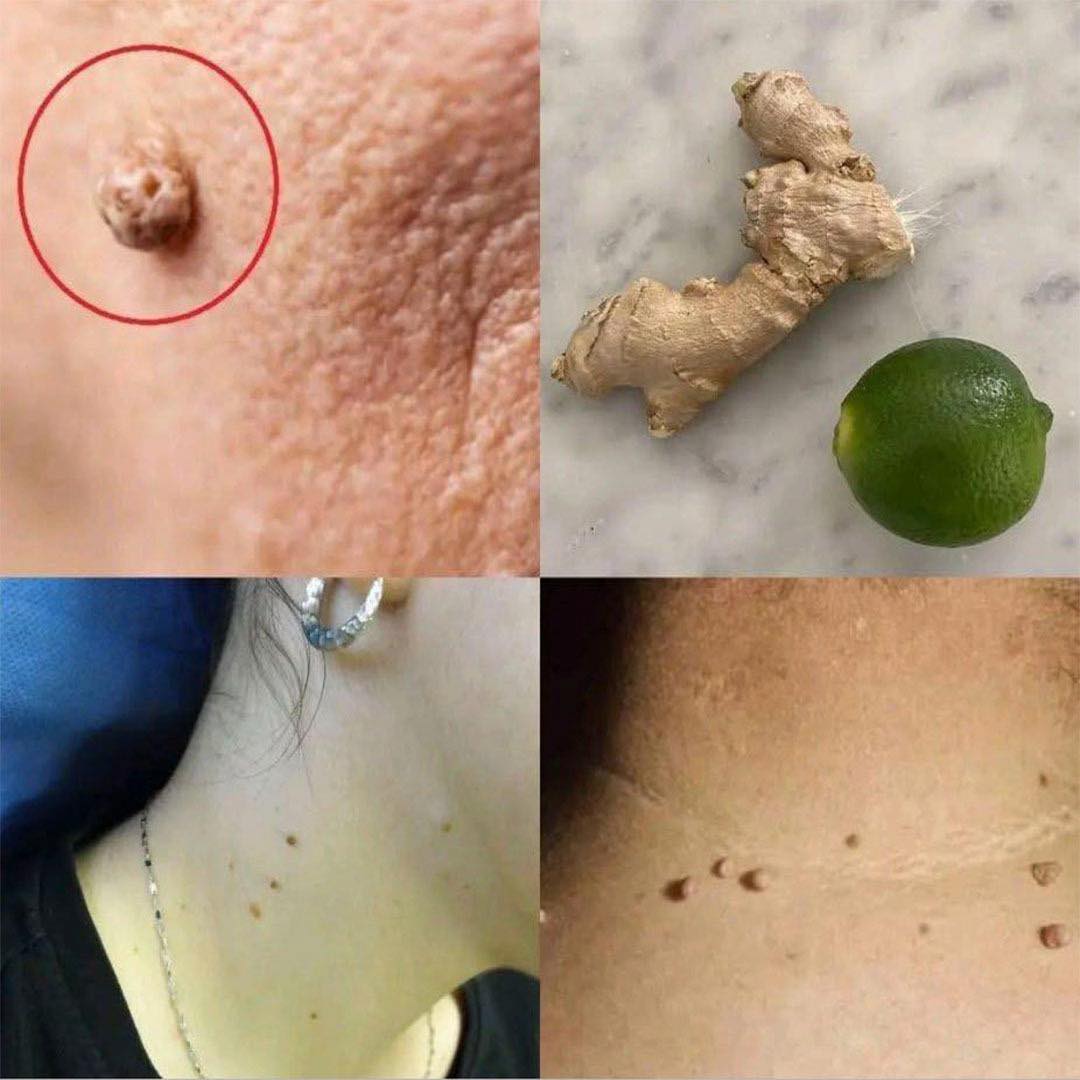 Remedios naturales para verrugas con jengibre y limón