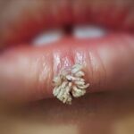 Remedios Naturales para Aliviar Lesiones Comunes: Soluciones Efectivas y Saludables