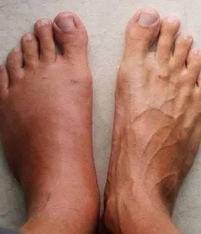 Signos de un infarto