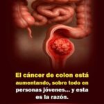 Cáncer de Colon en Jóvenes: Cómo Prevenirlo y Remedios Naturales