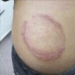 Causas y Remedios Naturales para la Irritación de la Piel