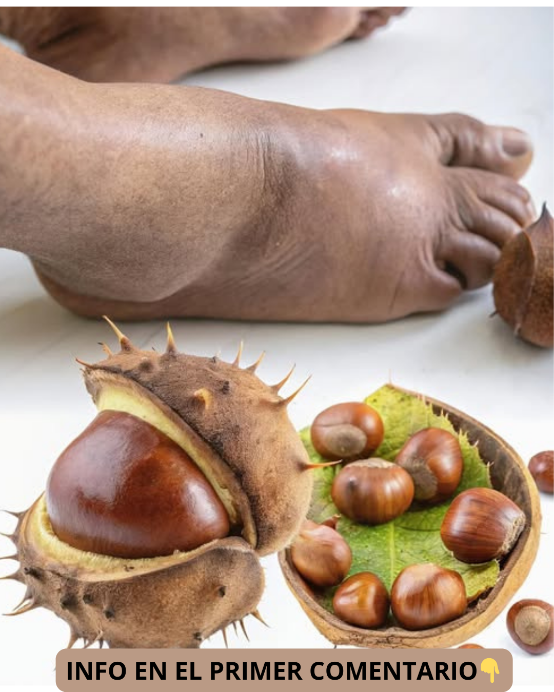 Castañas de indias junto a un pie hinchado