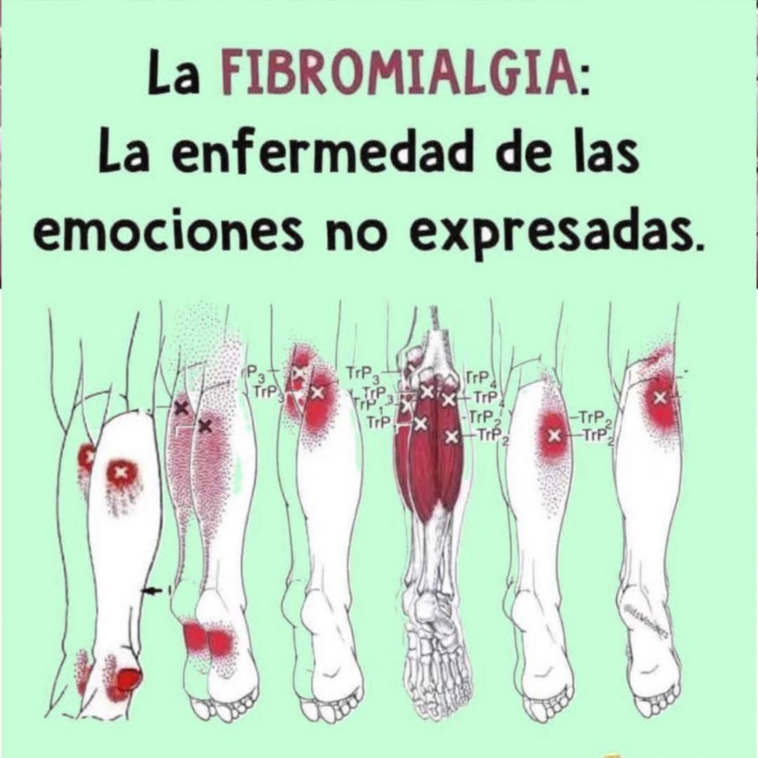 Áreas de dolor en la fibromialgia