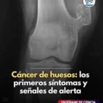 Cáncer de Huesos: Síntomas Tempranos y Medidas de Apoyo Natural