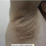 Identificación y Tratamiento de Acrocordones: Remedios Naturales y Caseros