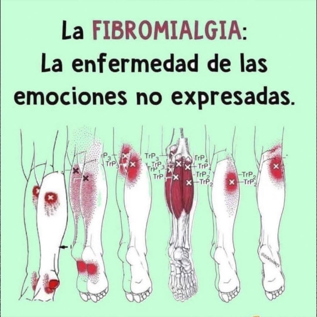 Ilustración de puntos de dolor de la fibromialgia