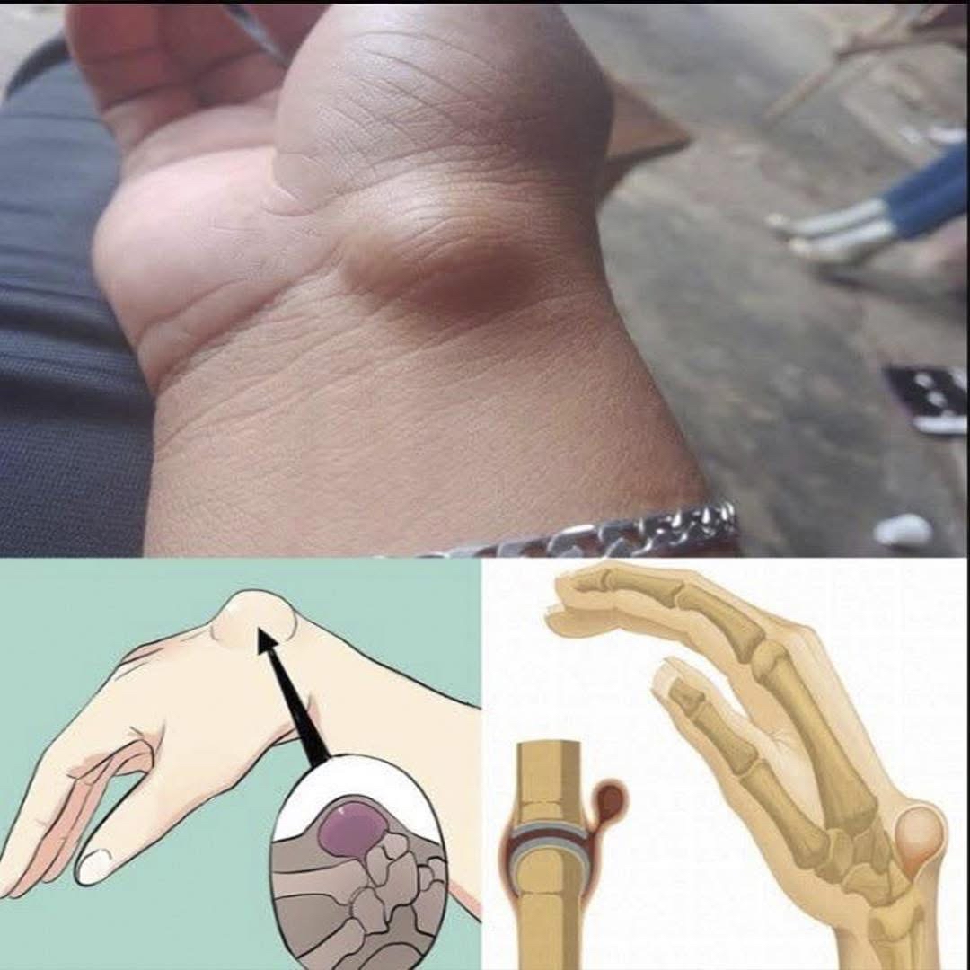 Quiste Sinovial en la Muñeca
