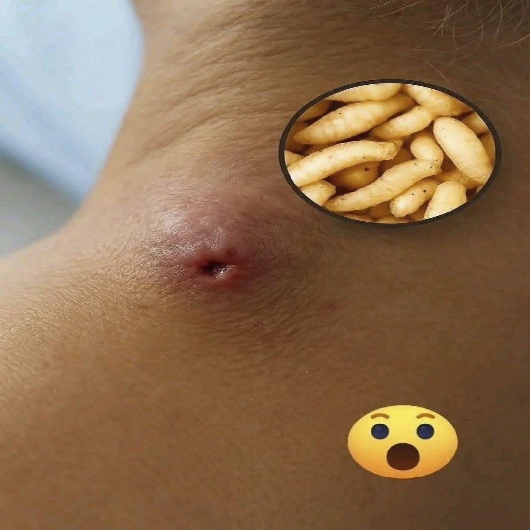 Lesión en la Piel Con Larvas