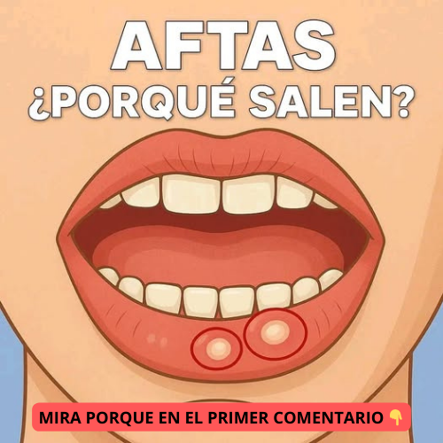 Ilustración de aftas bucales