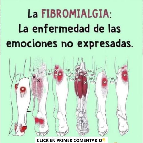 Ilustración de Fibromialgia