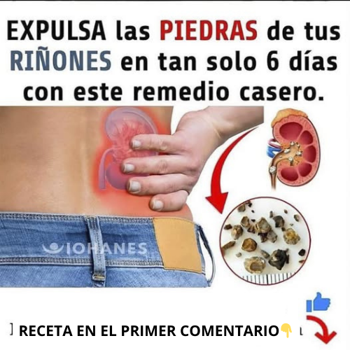 Proceso de expulsión de piedras de riñones