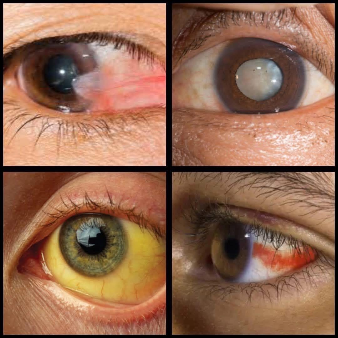 Condiciones Oculares