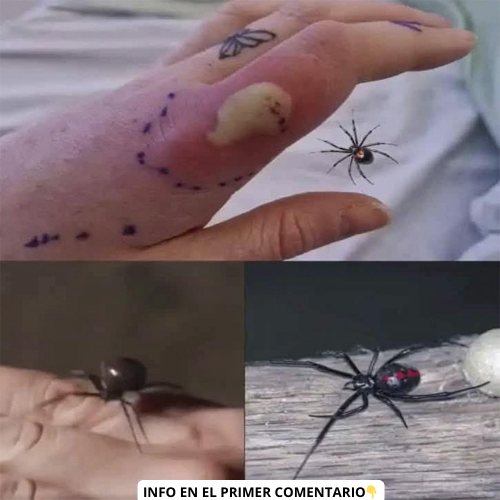 Mordedura de araña viuda negra