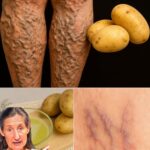 Diga Adiós a las Várices y a las Piernas Pesadas con este Método Natural