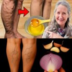 Remedios Caseros para Decir Adiós a las Venas Varicosas de Forma Natural