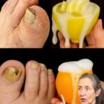 Eliminación de Hongos en las Uñas: Un Tratamiento 100% Natural
