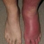 Soluciones Naturales para Pies Hinchados: Causas y Remedios