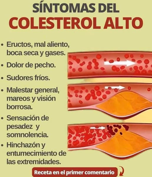 Síntomas del colesterol alto