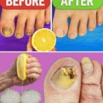 Eliminación de Hongos en las Uñas: Tratamiento Natural y Efectivo