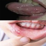 Descubre los Signos de que Estás Sufriendo de Aftas y Cómo Aliviar el Dolor