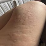 Identificando y Tratando la Urticaria: Remedios Naturales y Consejos de Salud