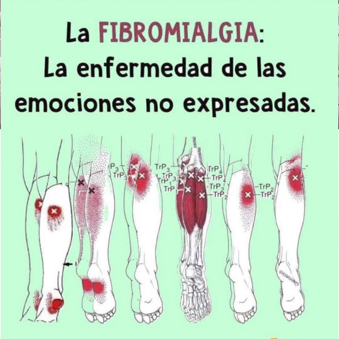 Gráfico de fibromialgia
