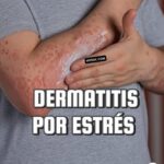 Dermatitis por Estrés: Cómo el Estrés Afecta tu Piel y Cómo Tratarlo