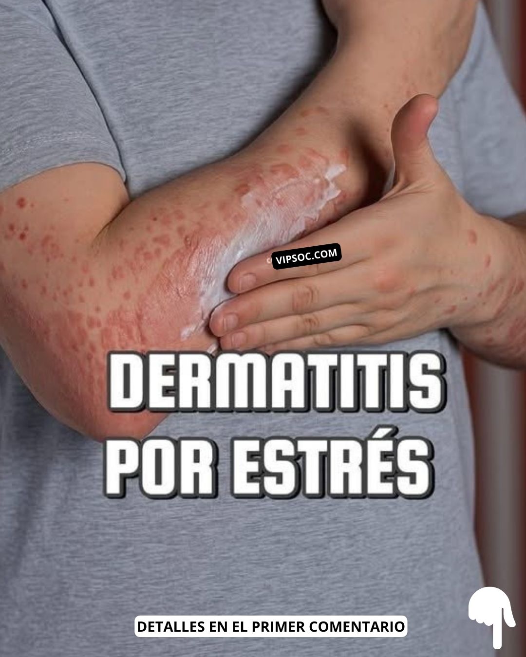 Dermatitis por estrés
