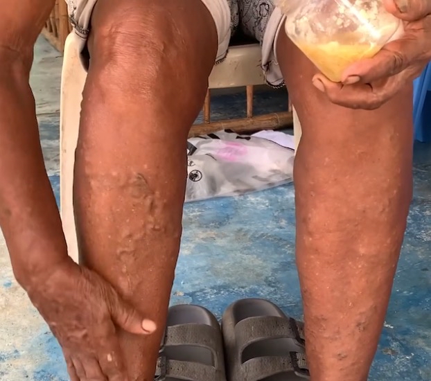 Crema Natural para el Pie Diabético