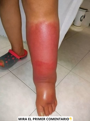 Síntomas de triglicéridos altos
