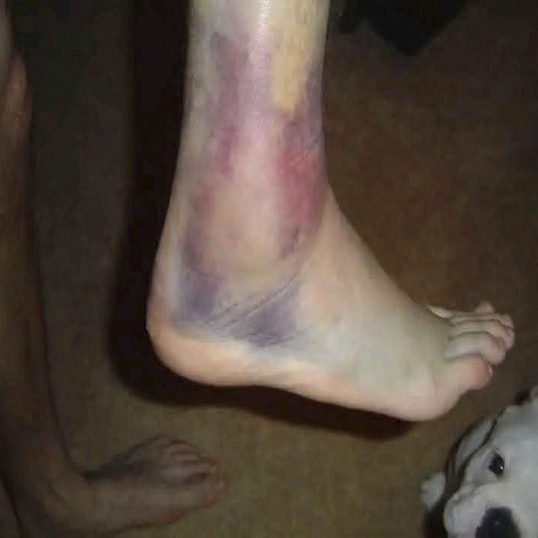 Tobillo Hinchado y Moretones