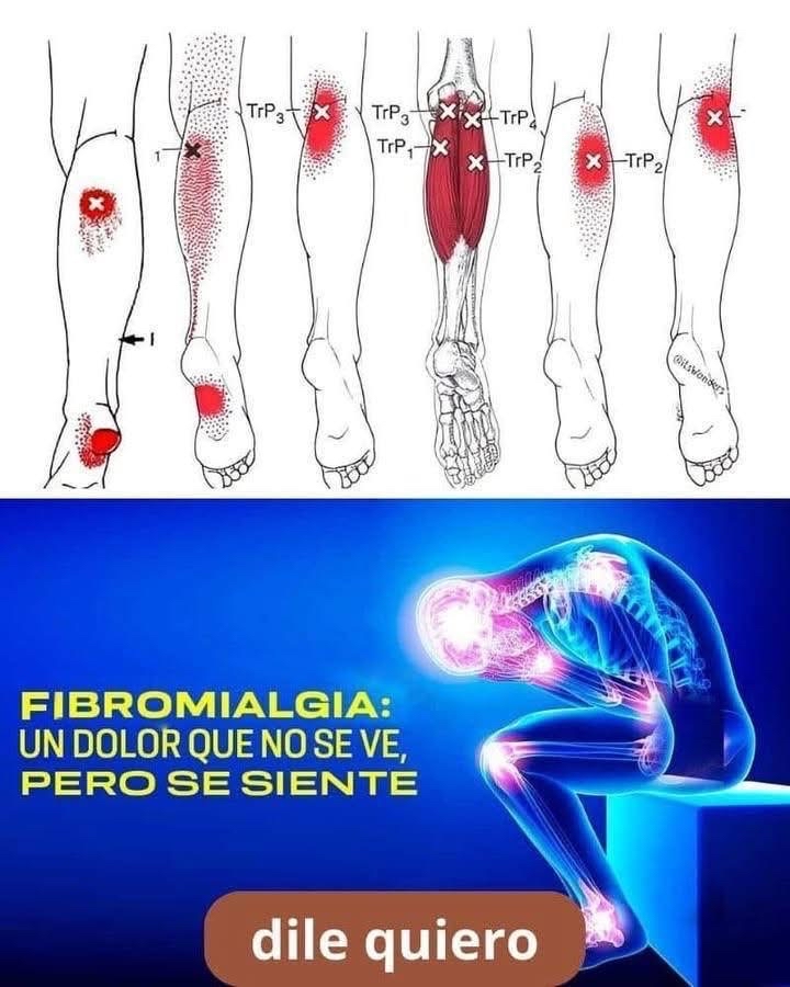 Puntos de dolor en Fibromialgia